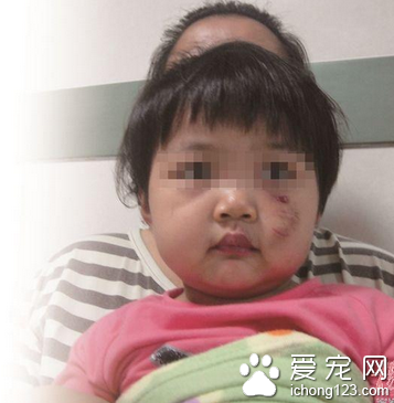2歲多女童小區內遭寵物狗撲襲 容貌損失嚴重