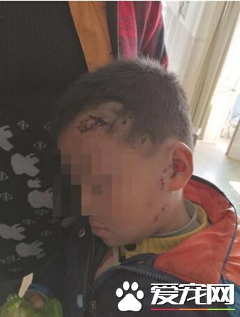 疑惹怒發情母狗 6歲男童下唇險咬甩縫20針