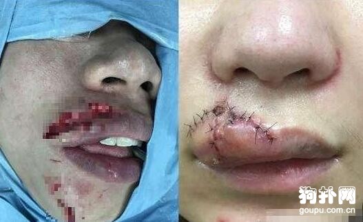 寵主強行要和狗狗親親，惹怒狗狗，嘴巴被咬爛