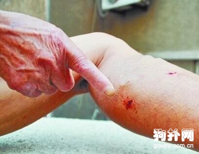 男子假裝被狗咬，以此行騙，半年內訛了數萬元