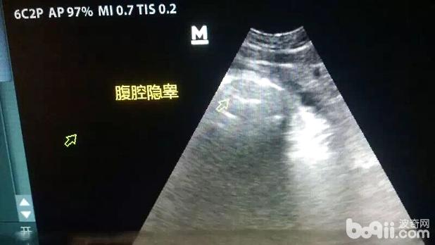 一例哈士奇隱睪的病例分析