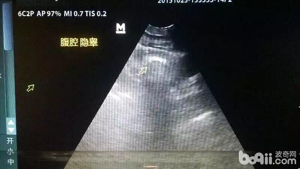 一例哈士奇隱睪的病例分析