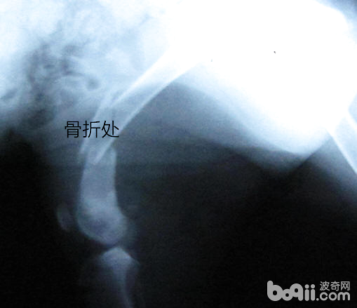 犬的肱骨骨折以及內固定